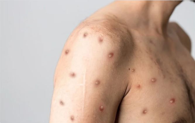 monkeypox in pakistan